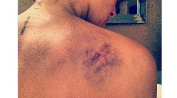 Αποκάλυψε την πλάτη της και είναι γεμάτη μελανιές