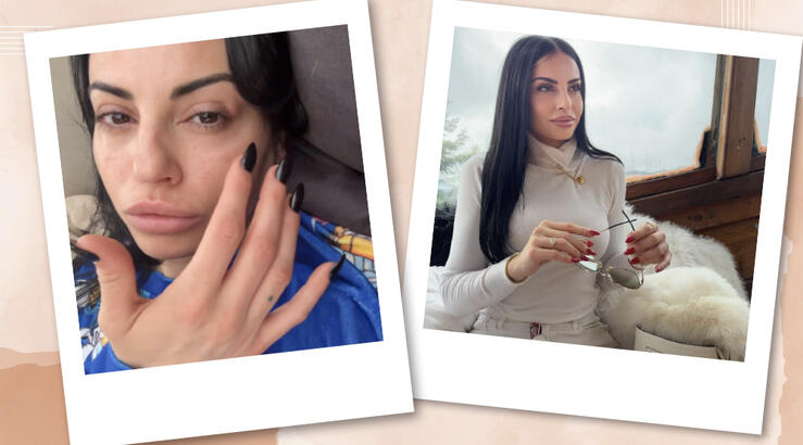 Η Δήμητρα Αλεξανδράκη έπαθε αλλεργική αντίδραση από sushi και πρήστηκε το πρόσωπό της [βίντεο]