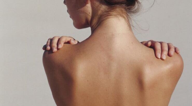 Ακμή στην πλάτη: Επίμονη και ενοχλητική 