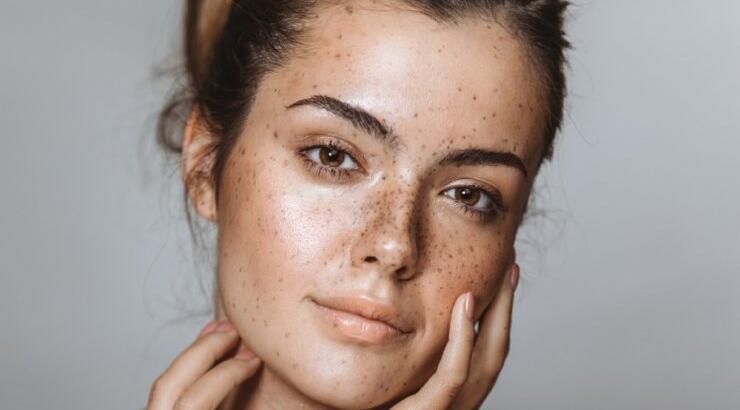 Πώς μπορούμε να απαλλαγούμε από τις ενοχλητικές πανάδες