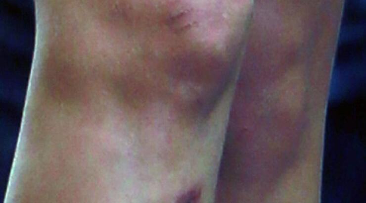 Οι μελανιές της Cara Delevigne [εικόνες]