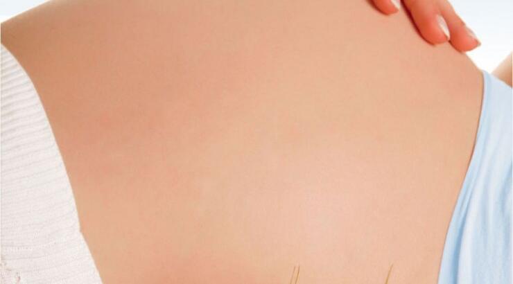 Πότε πρέπει να γίνεται μία καισαρική τομή; 