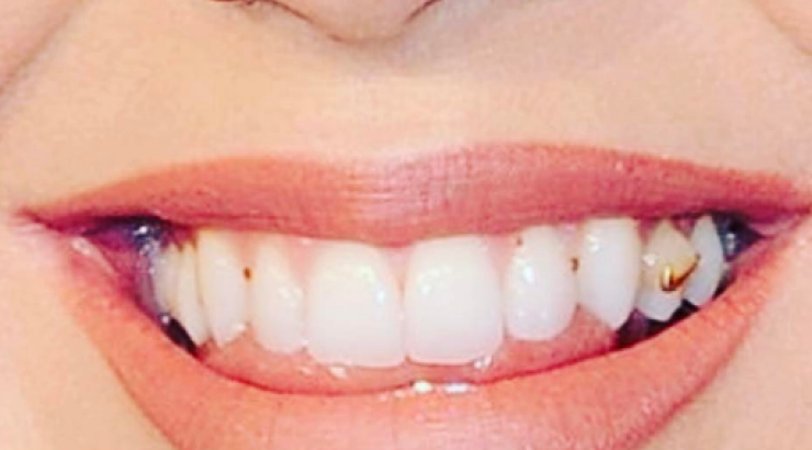 Απίστευτο κι όμως συνέβη! Πασίγνωστη τραγουδίστρια κυκλοφόρησε δημόσια με ακαθαρσίες στα δόντια!