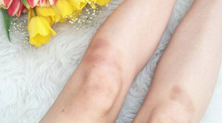 Επώνυμη Κύπρια με μώλωπες στα πόδια!