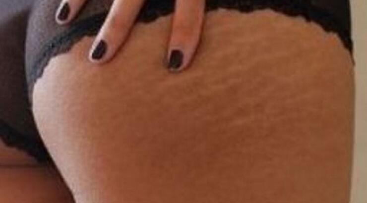 Εξάλειψη ραγάδων & κυτταρίτιδας για πάντα, εύκολα με μόνο 3 συστατικά!