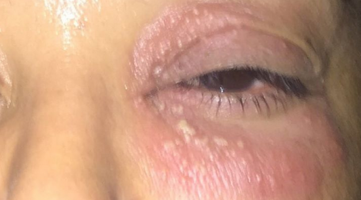 Τι συνέβη στο μάτι πασίγνωστης τραγουδίστριας;