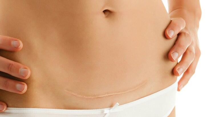 Έχω χειρουργηθεί πρόσφατα, πώς θα φροντίσω τις ουλές μου;