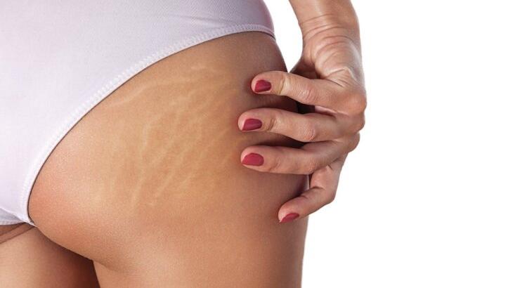 Ραγάδες: Αντιμετώπισε τις με φυσικές συνταγές που θα φτιάξεις μόνη στο σπίτι