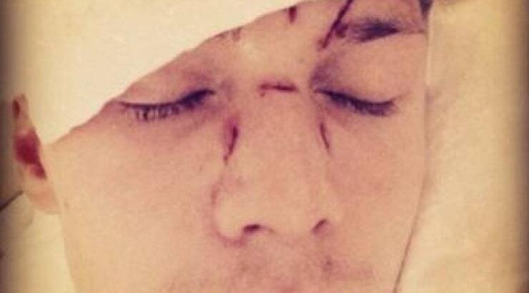 Άγρια χτυπημένος μετά απο καυγά ο αδερφός της Paris Hilton