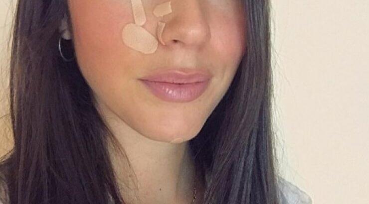 Ισμήνη Νταφοπούλου: Πώς είναι το πρόσωπό της τρεις μήνες μετά τον σοβαρό τραυματισμό