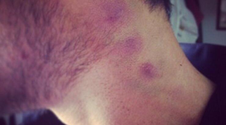 Ηθοποιός του Μπρούσκο με πιπιλιά στον λαιμό