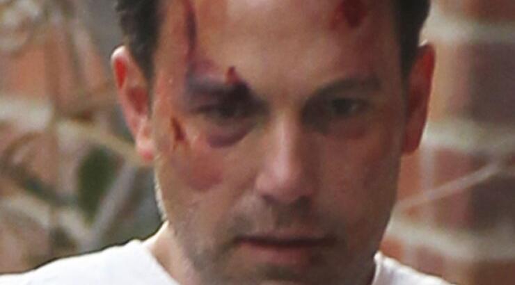 Σοβαρά τραυματισμένος ο Ben Affleck [εικόνες]