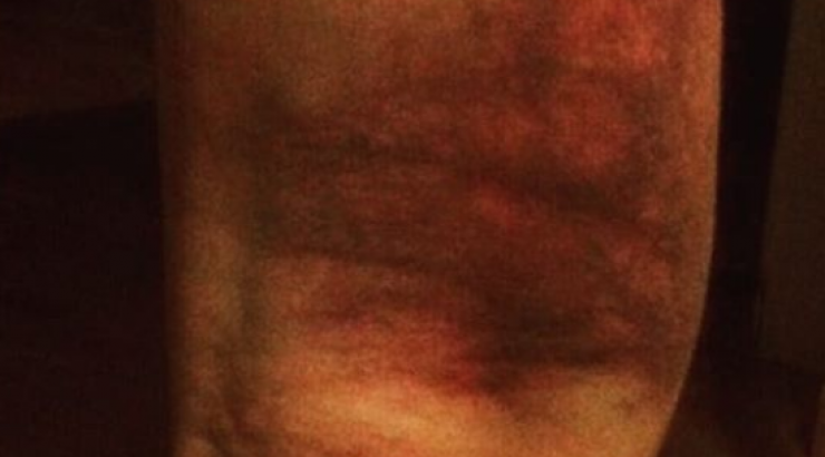 Σοκαριστικός τραυματισμός για επώνυμο Έλληνα!