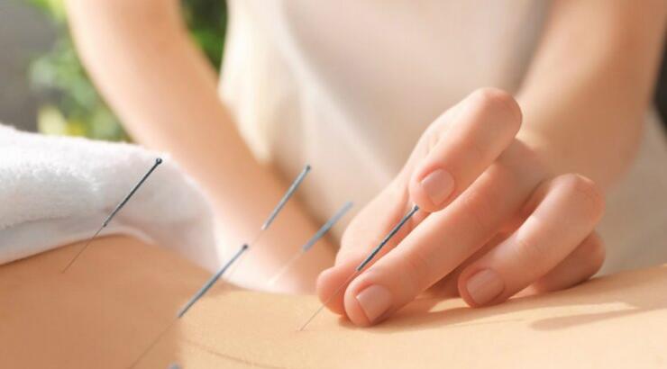 Βελονισμός: Τι είναι και τι μπορεί να θεραπεύσει;