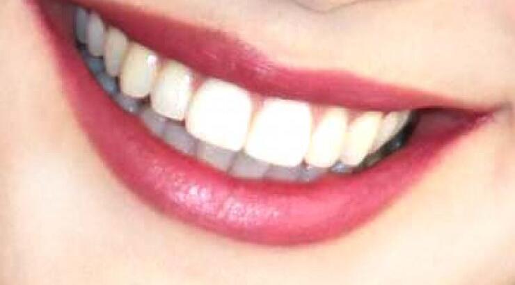 Τέλειο χαμόγελο