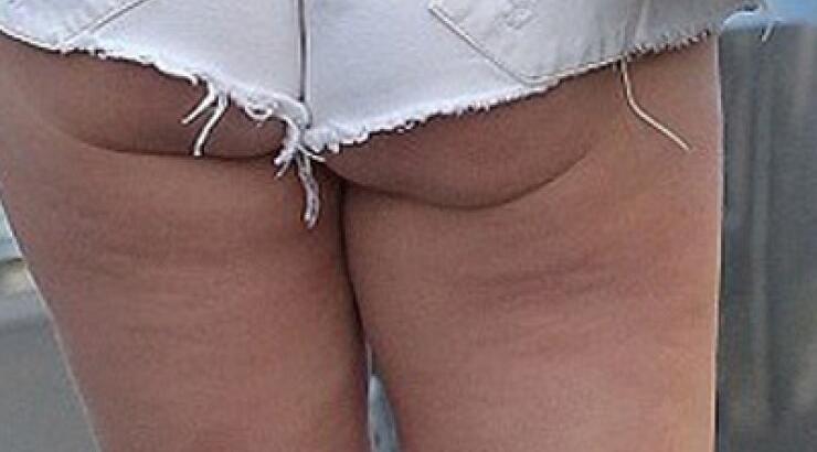 Η κυτταρίτιδα και η χαλάρωση σε εμφάνιση επώνυμης τραγουδίστριας