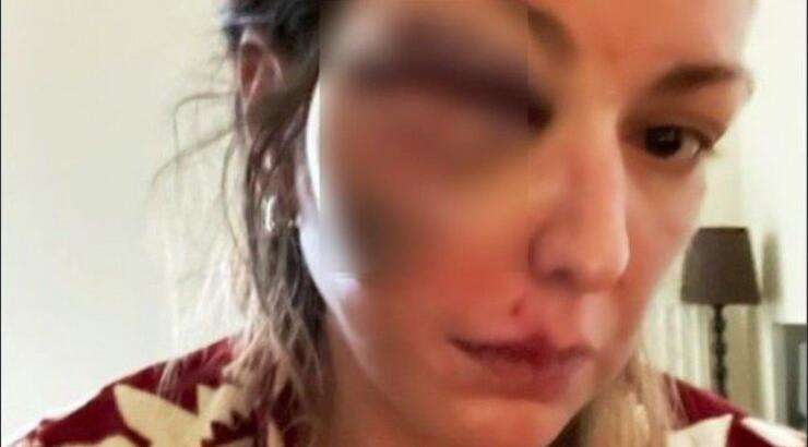 Σόκαρε όλους γνωστή Ελληνίδα: Πόσταρε φωτογραφία της μετά από ξυλοδαρμό