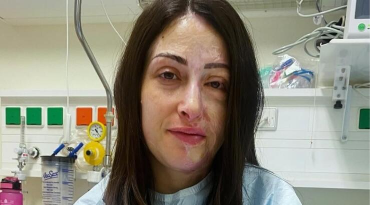 Ιωάννα Παλιοσπύρου: Η επίθεσή της από βιτριόλι έγινε ντοκιμαντέρ [βίντεο]