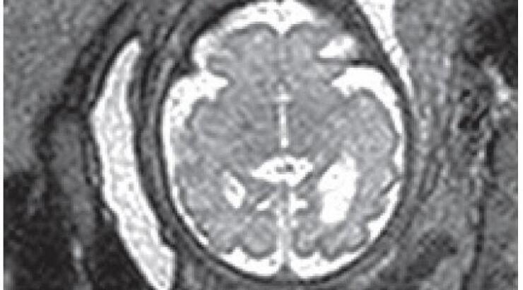 Προγεννητική μαγνητική τομογραφία για τον εγκέφαλο [Βίντειο]
