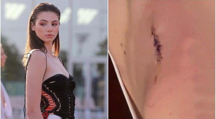 Συγκλονίζει η Μαριαγάπη Ξυπολιά: Μας δείχνει την πλάτη της - "Αφαίρεσα ένα ολόκληρο κομμάτι όγκου" [βίντεο]