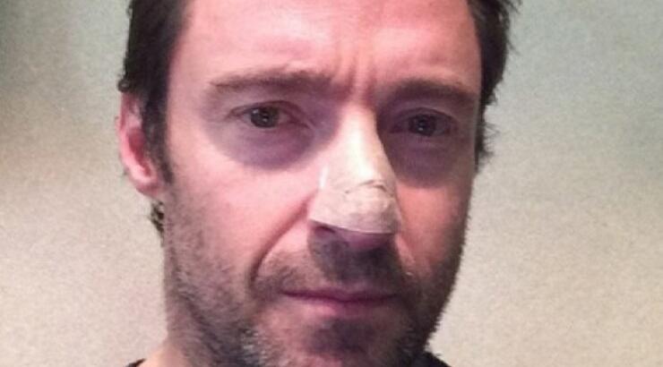 Με καρκίνο του δέρματος διαγνώστηκε ο Χιου Τζάκμαν 