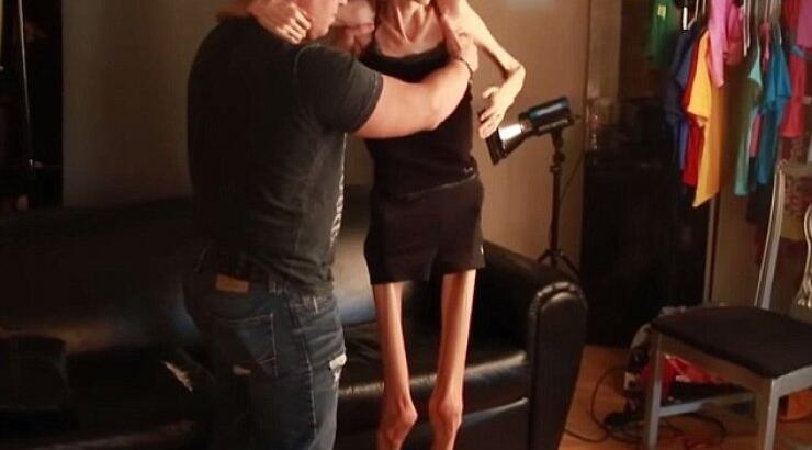 Αγνώριστη γνωστή ηθοποίος - Η μάχη με την ανορεξία - Ζυγίζει πλέον 18 κιλά και κανένα νοσοκομείο δεν την δέχεται