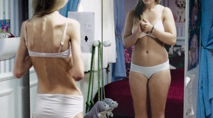 Βρέθηκε η θεραπεία κατά της ανορεξίας