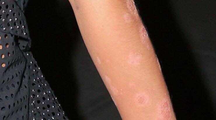 Πασίγνωστο μοντέλο έδειξε για πρώτη φορά τα σημάδια ψωρίασης στο σώμα της!
