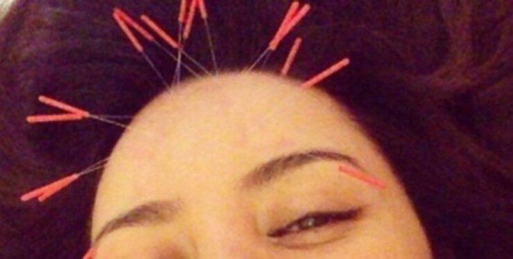  Ποια γνωστή Ελληνίδα ηθοποιός κάνει βελονισμό;