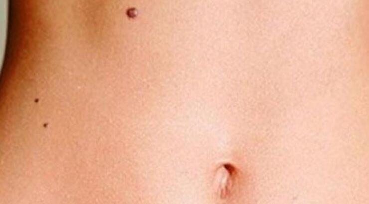 Ύποπτες ελιές: Τα 4 σημάδια που πρέπει να προσέξετε 