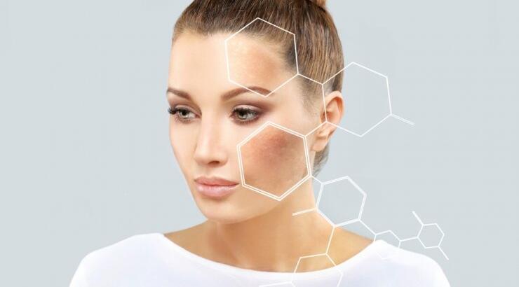 Μελάσματα ή πανάδες: Γιατί εμφανίζονται πάνω στο δέρμα και τι πρέπει να προσέξεις