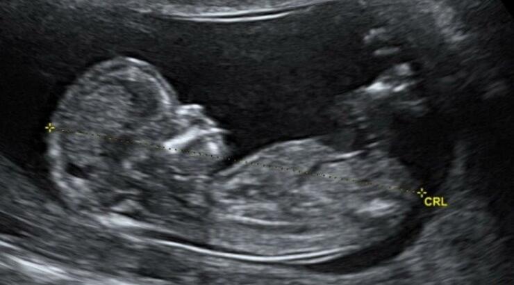 Ζευγάρι της showbiz περιμένει το πρώτο του μωράκι και μας έδειξαν το υπερηχογράφημα! 