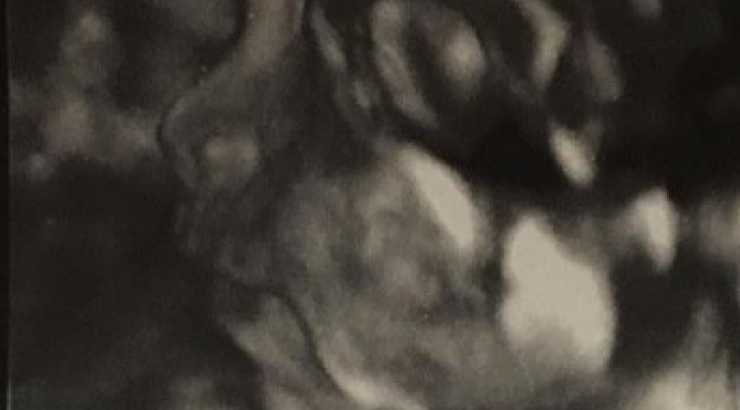 Διάσημο ζευγάρι χώρισε λίγο πριν φέρει στη ζωή το πρώτο του παιδάκι!