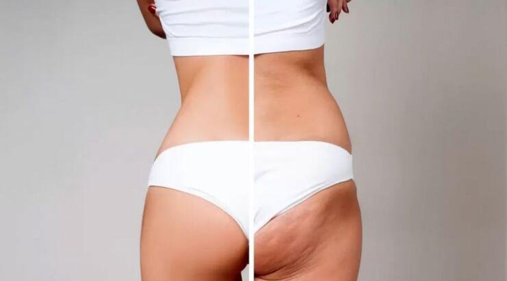 Εννέα τροφές που προκαλούν κυτταρίτιδα