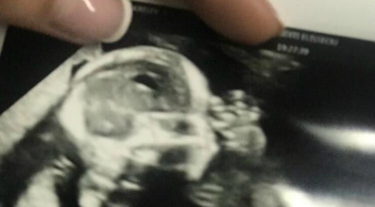 Επώνυμη Κύπρια μας έδειξε το υπερηχογράφημα του μωρού που περιμένει 
