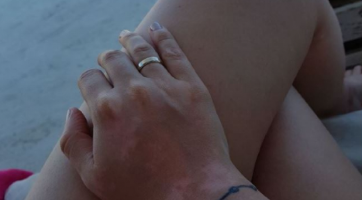 Επώνυμη Ελληνίδα αποκάλυψε για πρώτη φορά το πρόβλημα υγείας που την ταλαιπωρεί εδώ και μία δεκαετία!