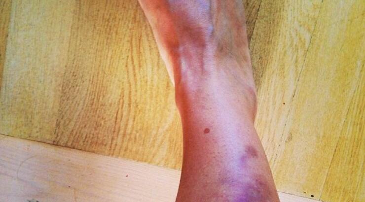 Με μελανιασμένο πόδι Ελληνίδα παρουσιάστρια