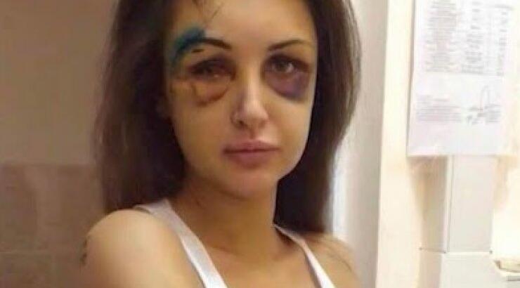 Φωτογραφίες σοκ: Ρώσος εκατομμυριούχος ξυλοκόπησε τo μοντέλο φίλη του