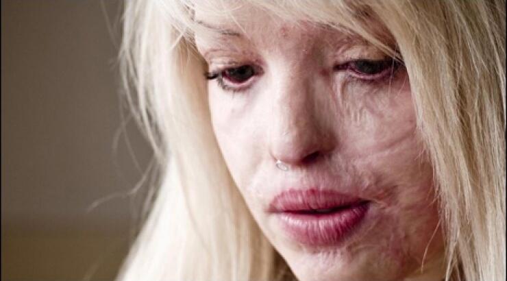 Πώς είναι σήμερα η παρουσιάστρια που δέχθηκε επίθεση με οξύ;