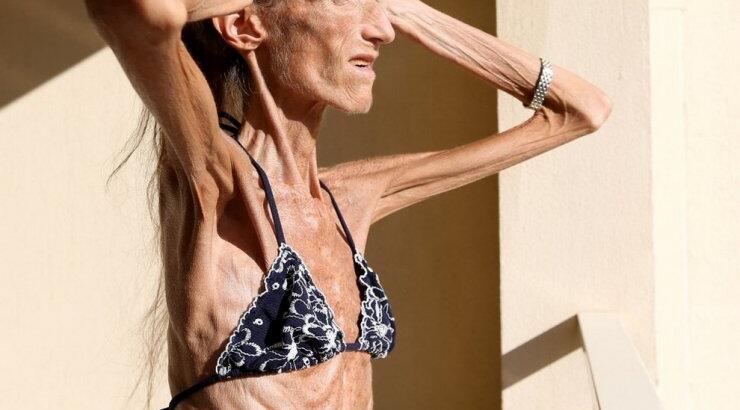 Γυναίκα εξομολογείται για τη νευρική ανορεξία [βίντεο]