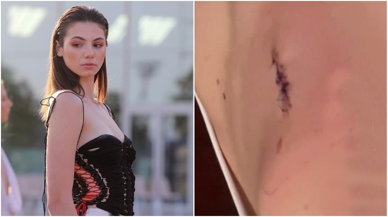 Συγκλονίζει η Μαριαγάπη Ξυπολιά: Μας δείχνει την πλάτη της - "Αφαίρεσα ένα ολόκληρο κομμάτι όγκου" [βίντεο]