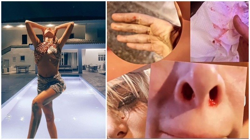 Θύμα άγριου ξυλοδαρμού πασίγνωστη Ελληνίδα: Εικόνες με αίματα και μώλωπες