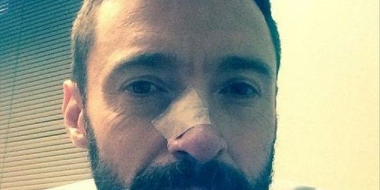 Hugh Jackman: Επέμβαση για αφαίρεση καρκινώματος