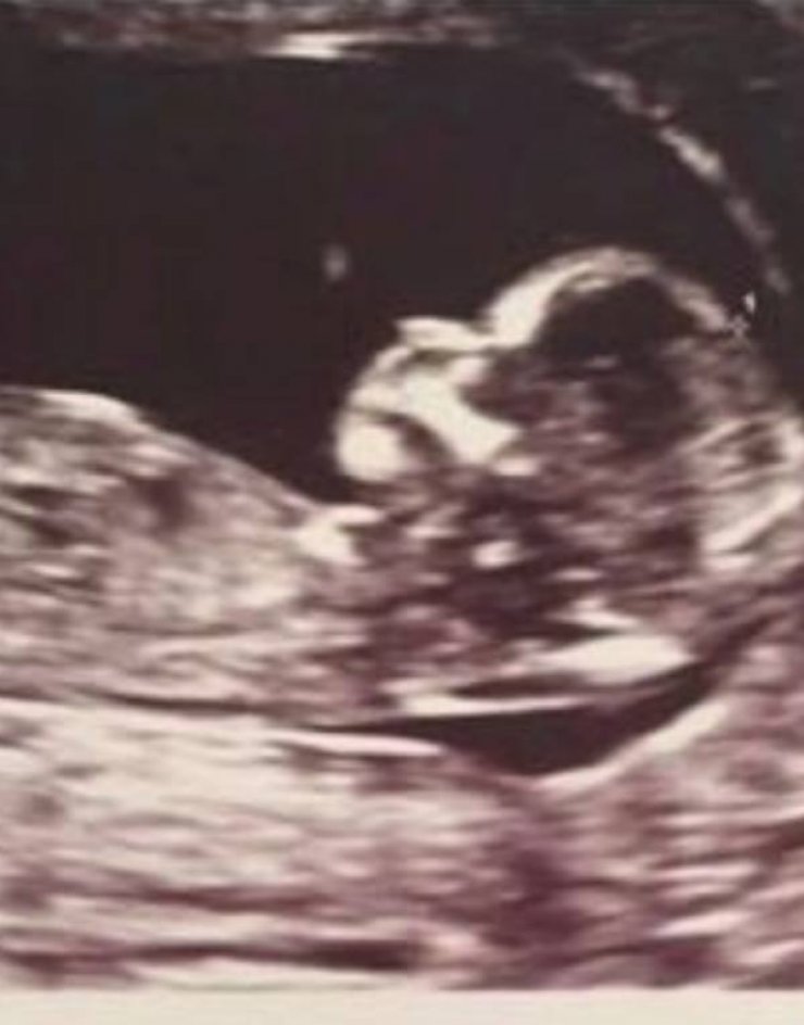 Κύπρια ηθοποιός ανακοίνωσε την εγκυμοσύνη της μετά από μια σκληρή μάχη με τον καρκίνο