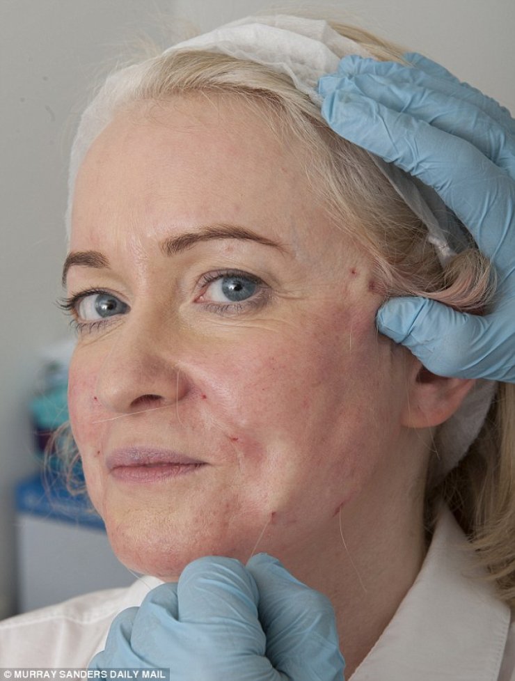 Νέου τύπου λίφτινγκ: Σφίγγουν το δέρμα με νήματα [εικόνες]