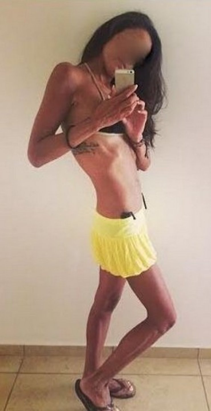 Εικόνα σοκ: Πρώην Miss Ελλάς πάσχει από ανορεξία;