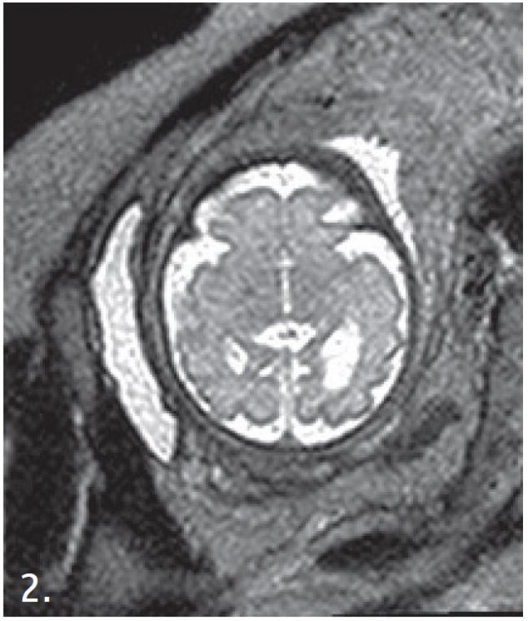 Προγεννητική μαγνητική τομογραφία για τον εγκέφαλο [Βίντειο]