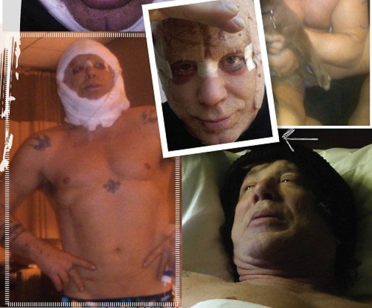 Mickey Rourke: Δείτε τις photos μετά την τελευταία πλαστική