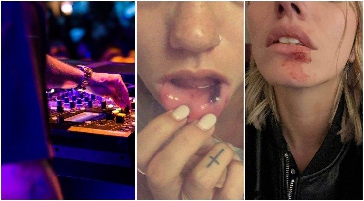 Συγκλονίζουν οι εικόνες του ξυλοδαρμού Ελληνίδας μοντέλου από τον dj πρώην σύντροφο της