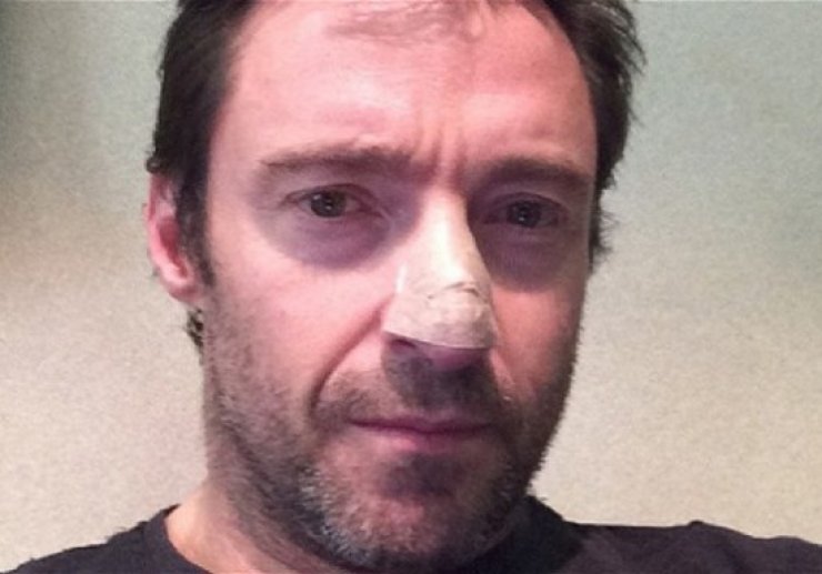 Με καρκίνο του δέρματος διαγνώστηκε ο Χιου Τζάκμαν